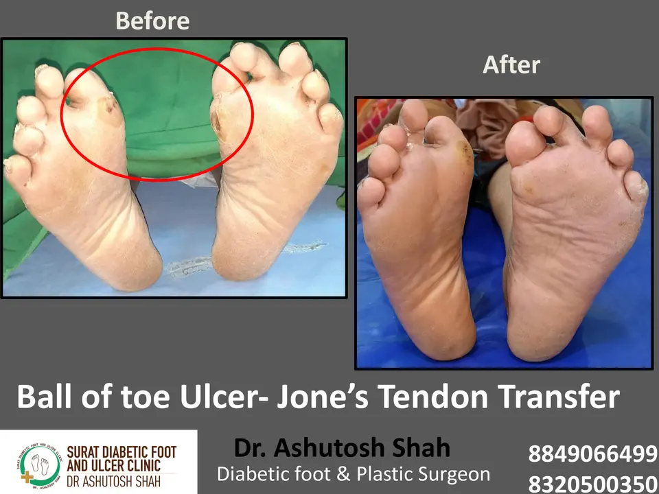 Diabetic Foot  PPT 3 checked by sir.pptx-36.webp